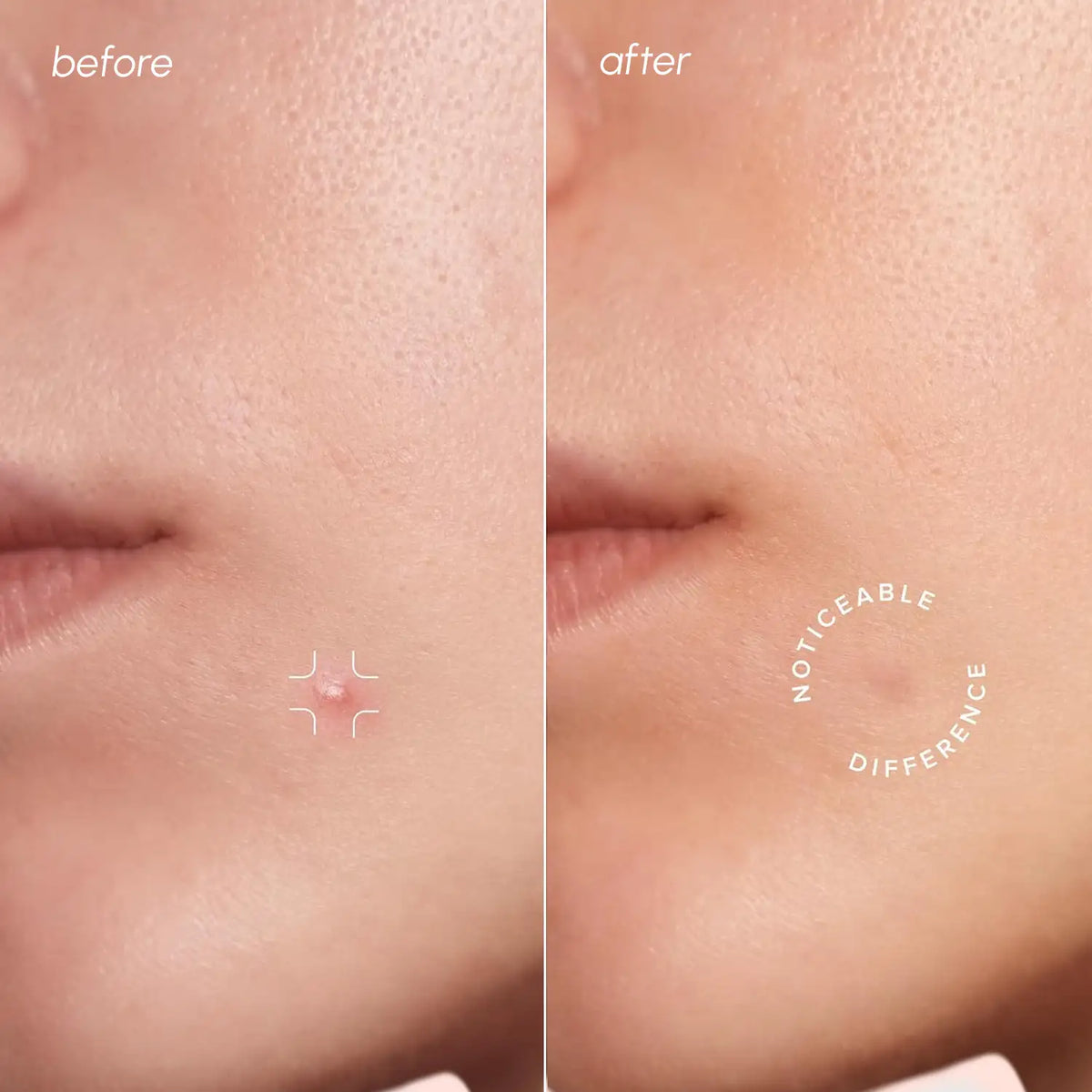 Invisible pimple patches – view 2