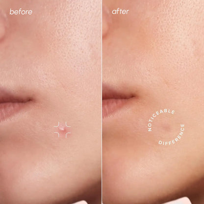 Invisible pimple patches – view 2