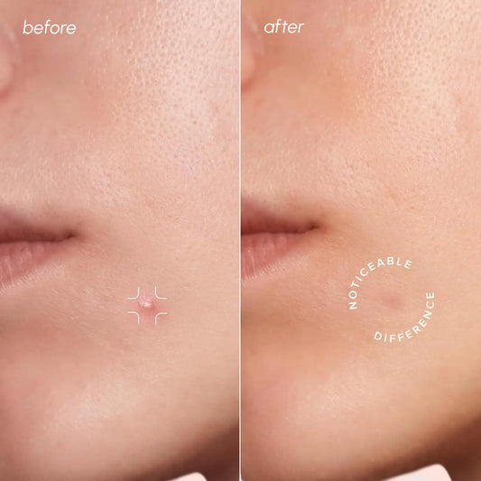 Invisible pimple patches – view 2
