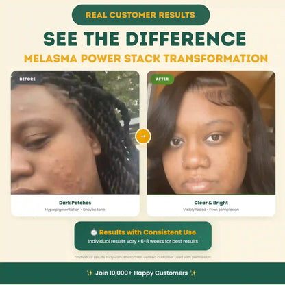 Melasma Power Stack by AMVital