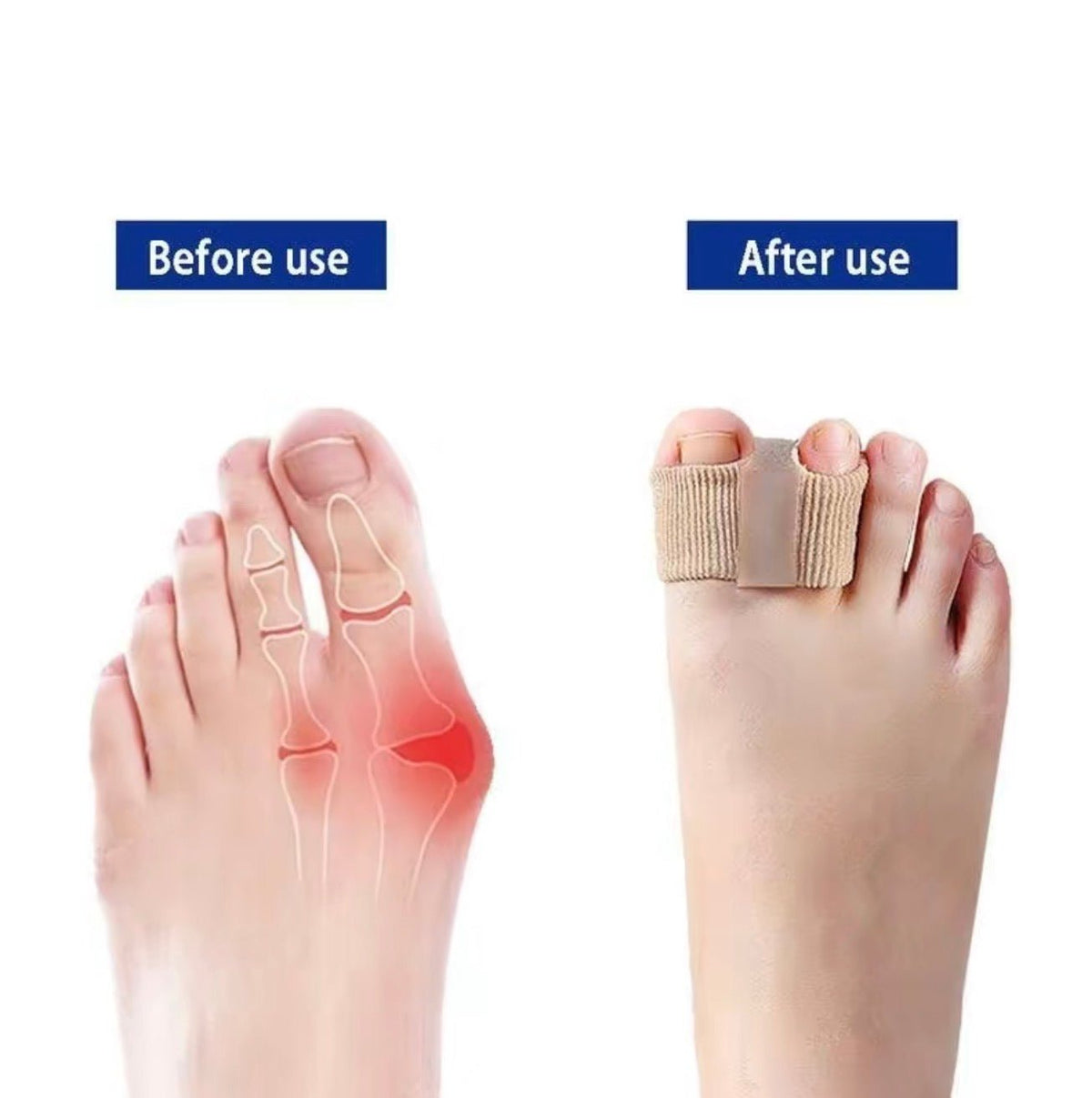 BunionEase Toe SeparatorsTorqelo.com