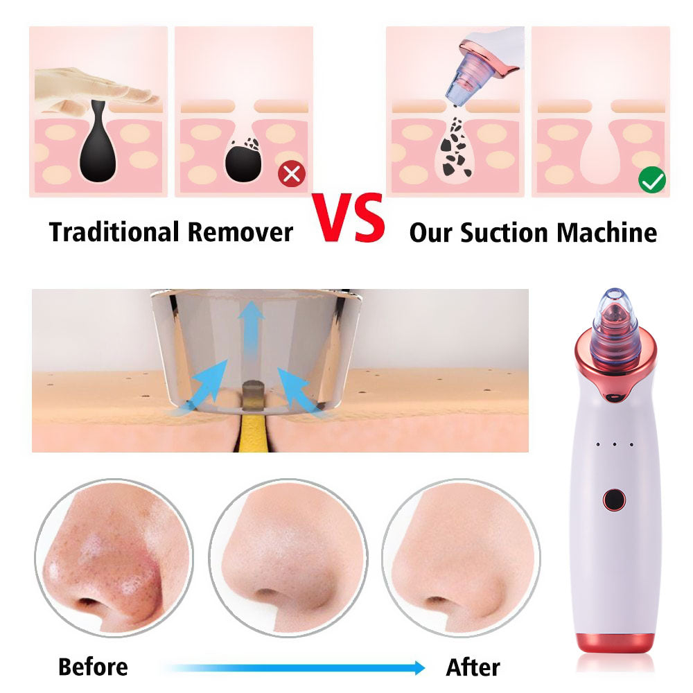 Electric Acne Remover Blackhead Remover Apparatus by Teal Simba